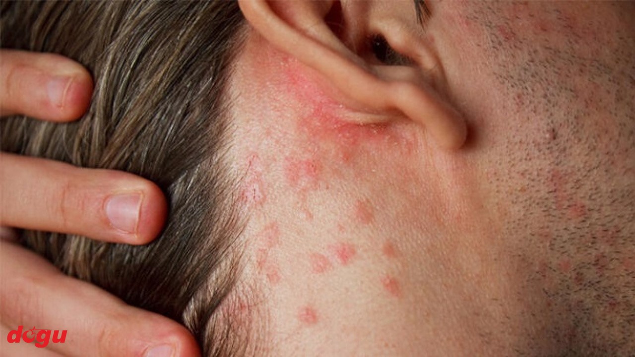 Uyuz alarmı! Krem işe yaramıyor hapı SGK karşılamıyor peki ne yapmalı (1)_1280x720